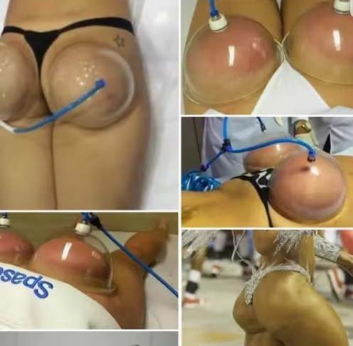 Woman using a vacuum suction cupping therapy device for natural breast and buttocks enlargement at home. Non-surgical body contouring with lifting pump cups for curves